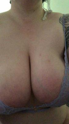 Seins veineux XLVI