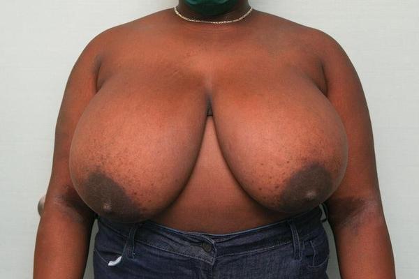 Pre surgery Black titties 